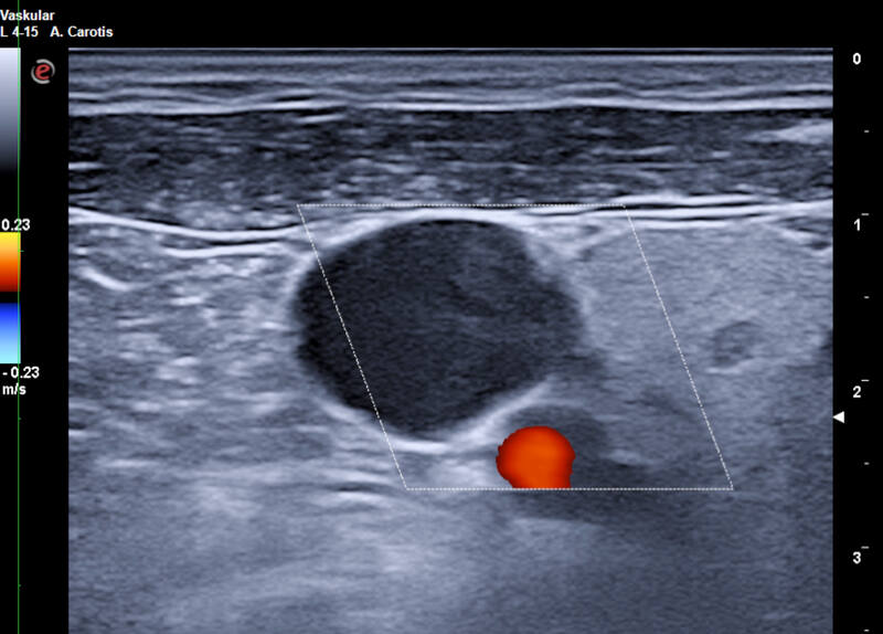 Normale Lage der Vena jugularis anterolateral der Arteria carotis